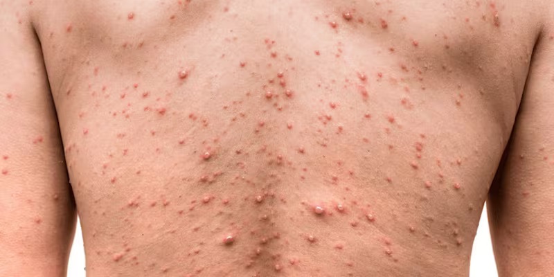 Un paciente sin viajar: el caso que encendió la alerta por el tipo más agresivo de la "Viruela del mono"